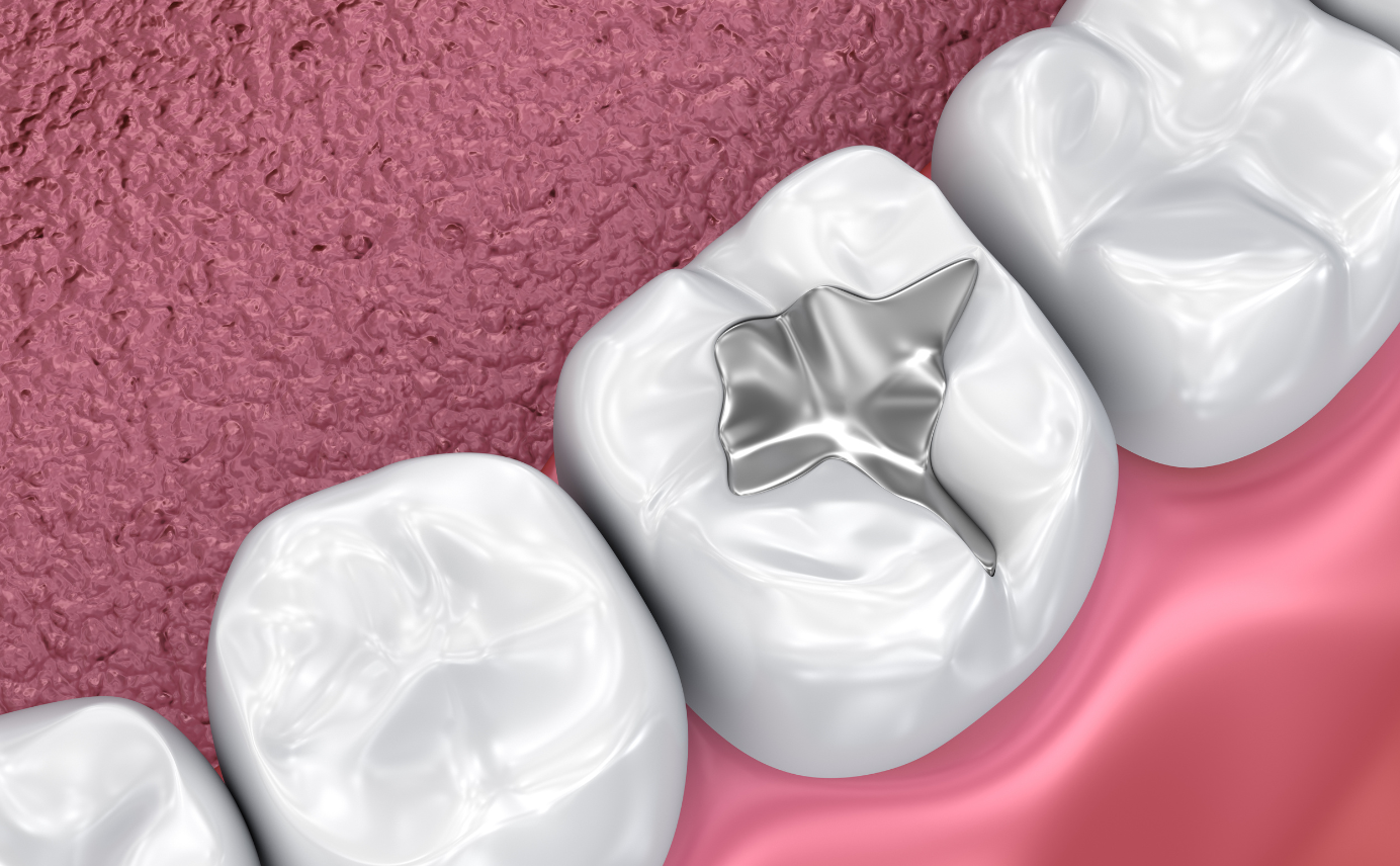 mercury_free_Glenview_dentist